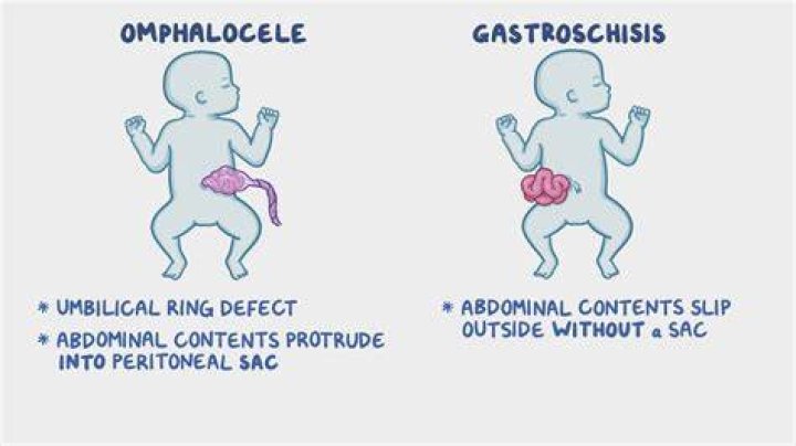 Can baby survive omphalocele?