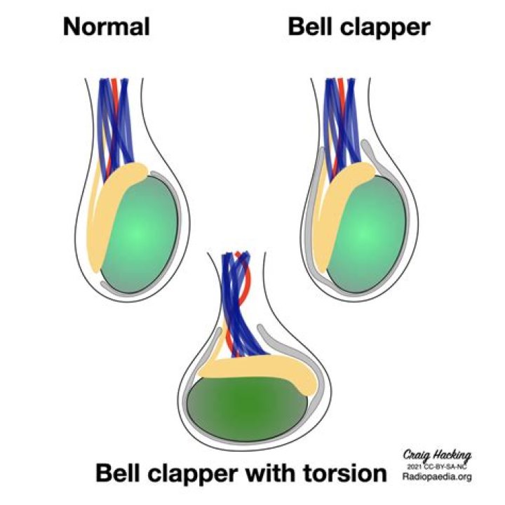 Can bell clapper deformity cause infertility?