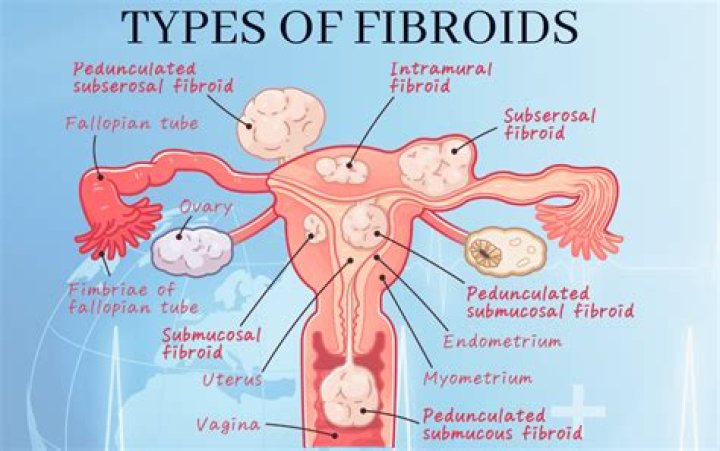 Does fibroids cause pain?