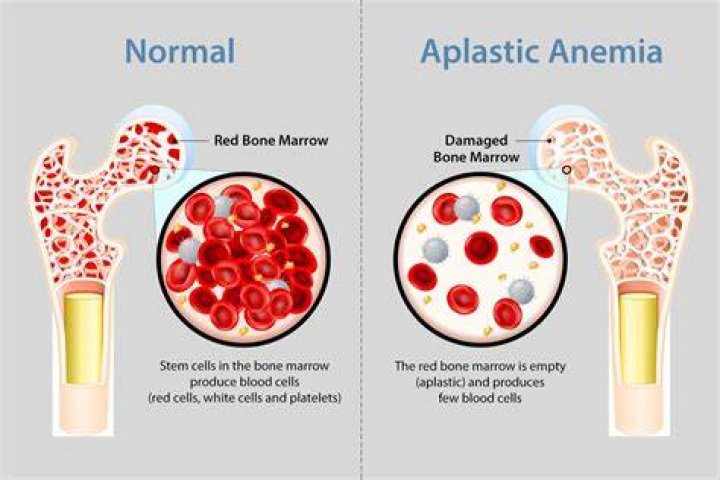 Does phenytoin cause aplastic anemia?