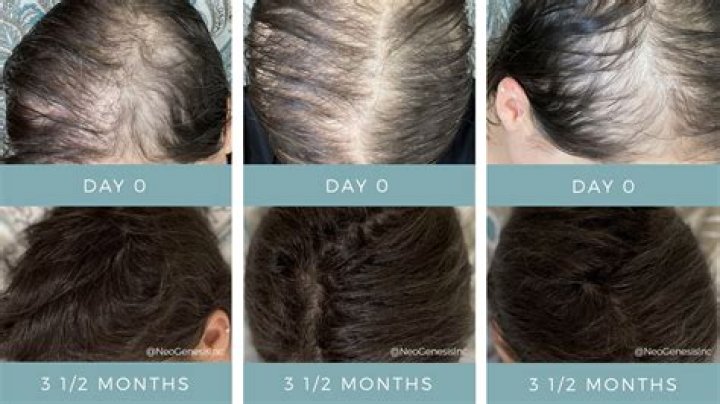 Does serum cause hair loss?