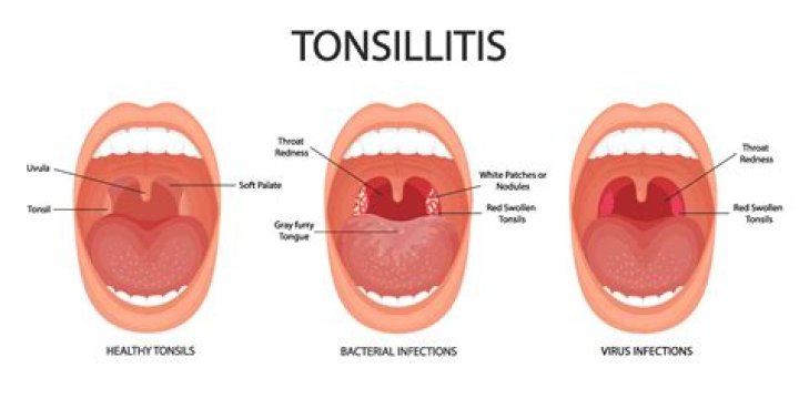 Were are tonsils located?