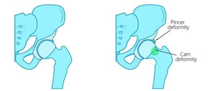 What is a cam deformity of the hip?