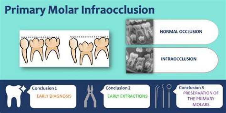 What is dental infraocclusion?