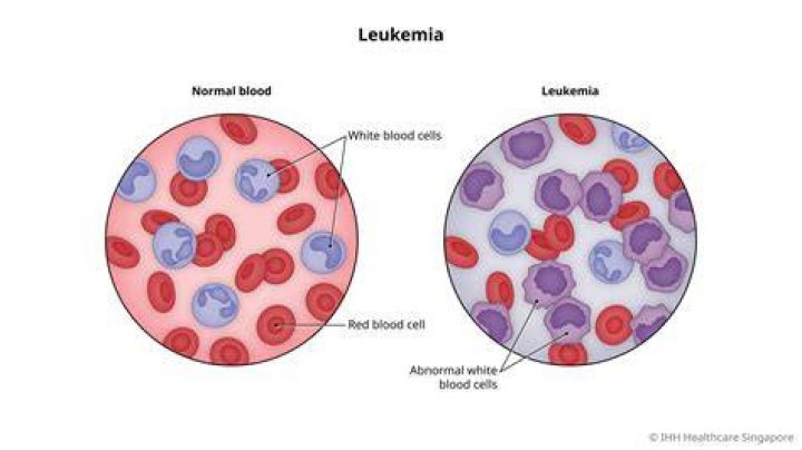 What type of cancer is acute lymphocytic leukemia?