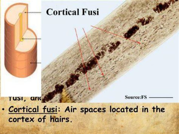 Whats a cortical fusi?