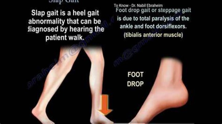 Why high stepping gait?