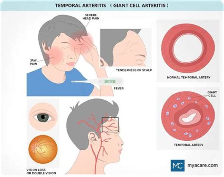 Will temporal arteritis go away?